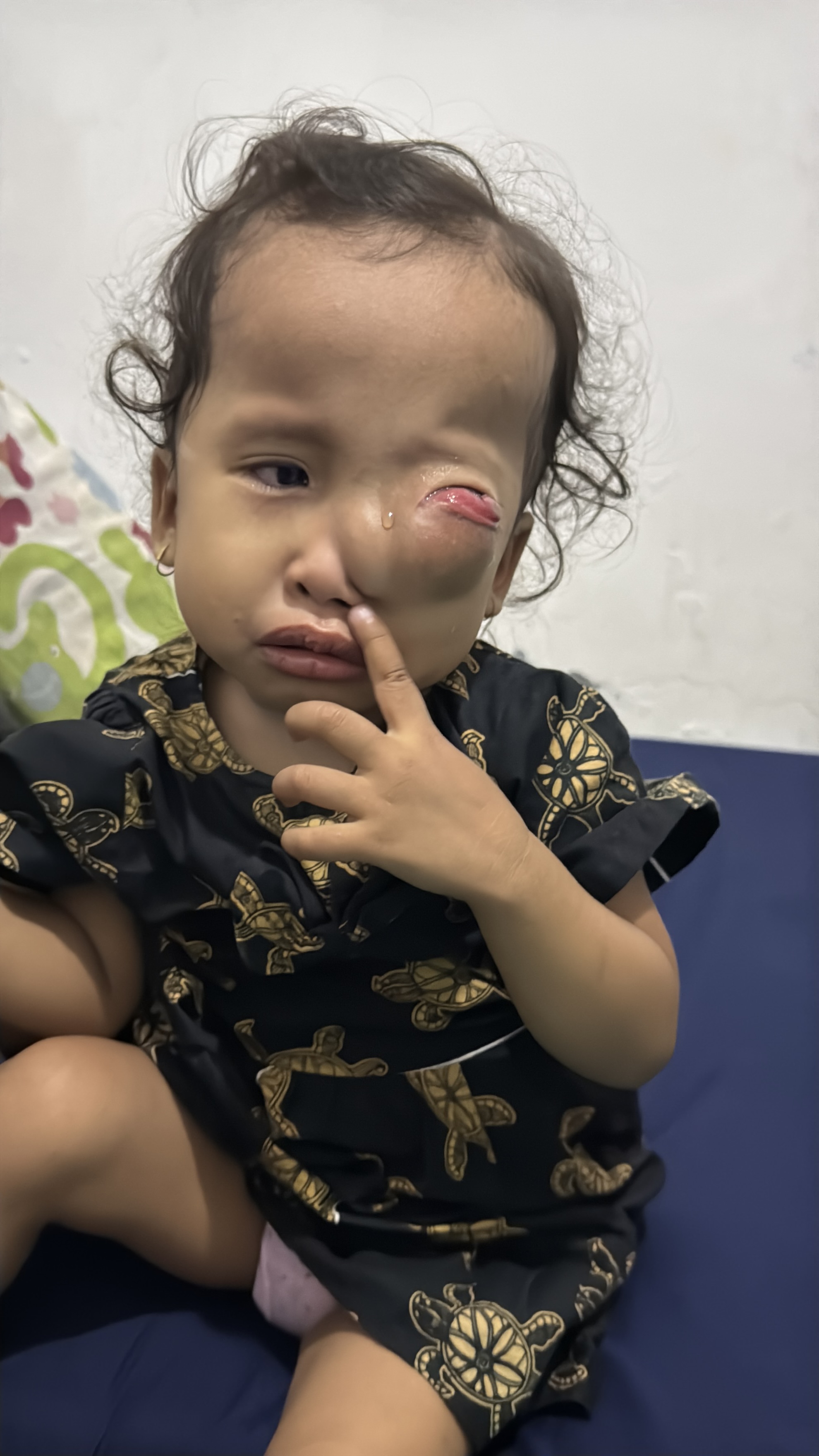 Tolong Anak Penjual Tisu Matanya Menonjol dan Tak Bisa Melihat