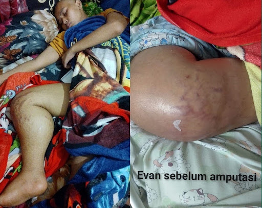 Evan, Remaja Aktif yang Melawan Kanker Tulang 